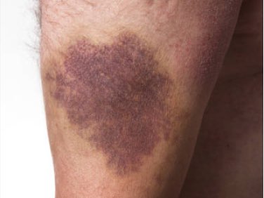 Image of an arm bleed.